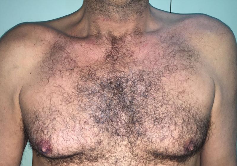 Gynecomastia Egypt, Male Breast Reduction Egypt, Breast Lift, Cosmetic Surgery
