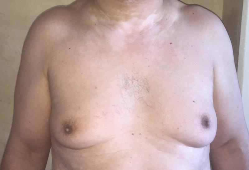  شفط الدهون بالليزر لتصغير حجم الصدر التثدي، افضل جراح تجميل في مصر ، تثدي رجال