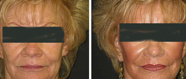 Anti ageing Egypt Laser Erbium Ablative Plastic Cosmetic CO2