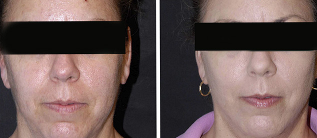 Pitting Ablative Laser Egypt Plastic Surgery Abroad Tourism Erbium Nd-YAG