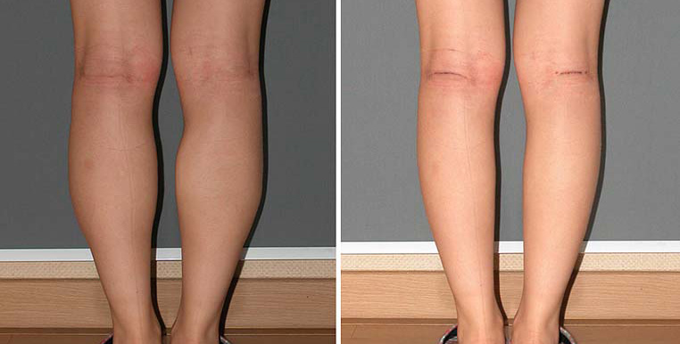 Cosmetic Surgery in Egypt Fat Liposuction calf lift implant  cairo tuck 