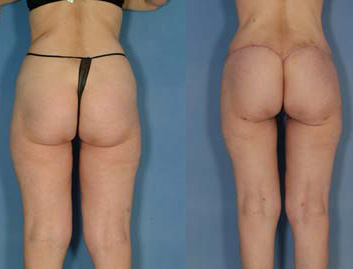 Buttock lift implant egypt plastic surgery cairo tuck 