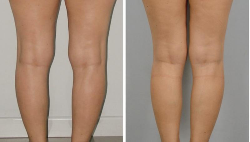 Calf leg lift implant egypt plastic surgery cairo tuck 