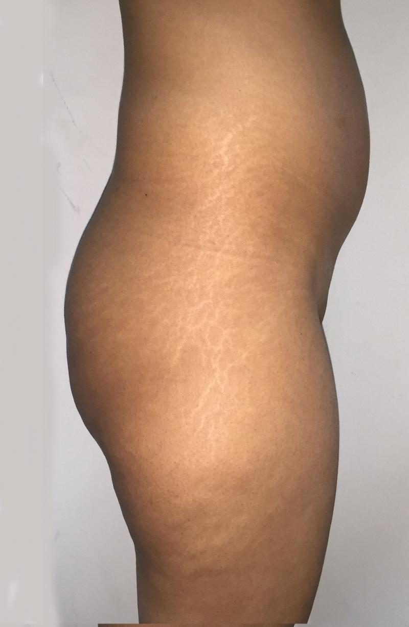 Buttock Enlargement, Buttock Enhancement, Fat Injection, Best Cosmetic Surgery
