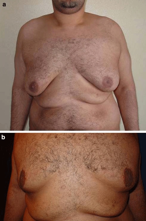Gynecomatia,breast,male,reduction,egypt,cairo,cosmetic surgery,fat,liposuction