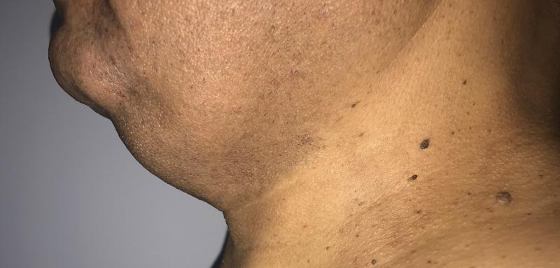 Necl Liposuction, 4D Neck Vaser Liposuction, High Definition Neck Liposuction