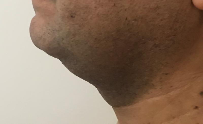 Necl Liposuction, 4Dimen Neck Vaser Liposuction, High Definition Neck Liposuctio