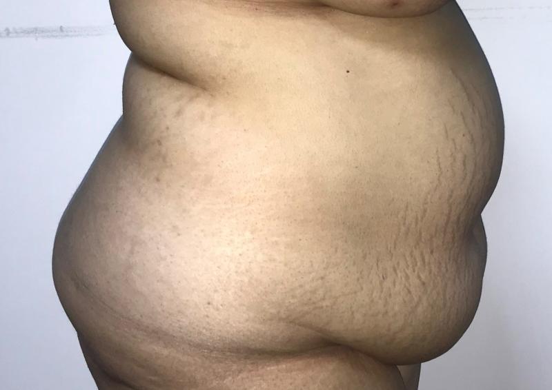 4D High Definition Vaser Tummy and Flank and Love Handles Liposuction, Cosmetic