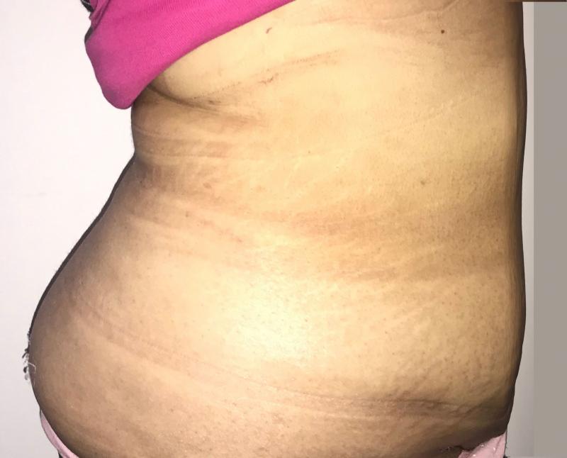 4D High Definition Vaser Tummy and Flank and Love Handles Liposuction, Plastic