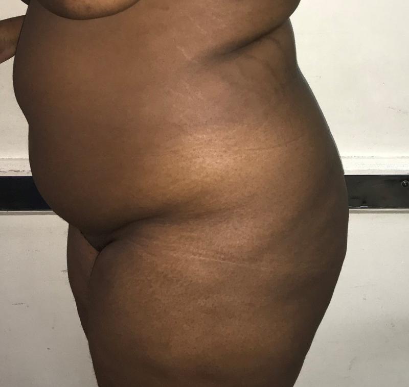 Smart 4D Vaser Liposuction, Brazilian Butt Lift, Best Plastic Surgery, Abdominal