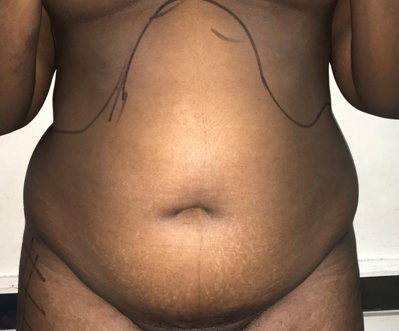 Smart 4D Vaser Liposuction, Brazilian Butt Lift, Best Cosmetic Surgery, Abdomina