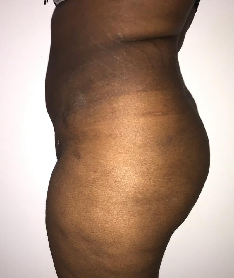 Smart 4D Vaser Liposuction, Brazilian Butt Lift, Best Aesthetic Surgery, BBL