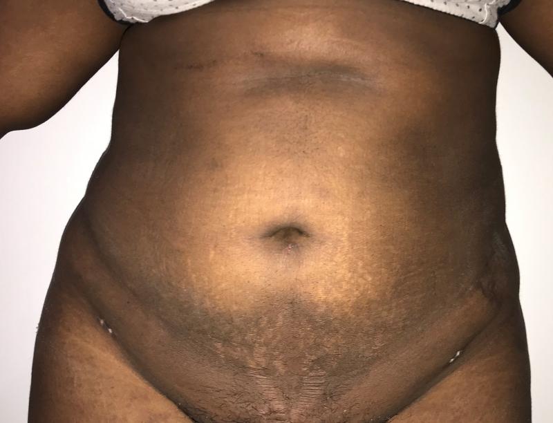 Smart 4D Vaser Liposuction, Brazilian Butt Lift, Best Aesthetic Surgery, Abdomic