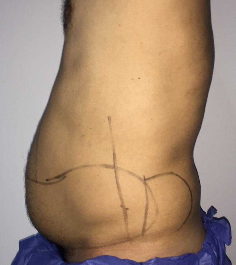 6 pack High Definition 4 D Vaser Smart Liposuction, Best Cosmetic Surgery Egypt
