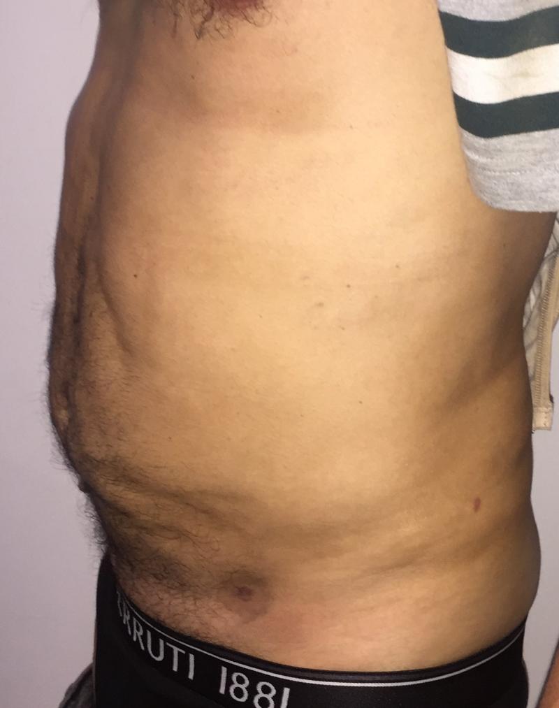 6 pack High Definition 4 D Vaser Smart Liposuction, Best Plastic Surgery Egypt