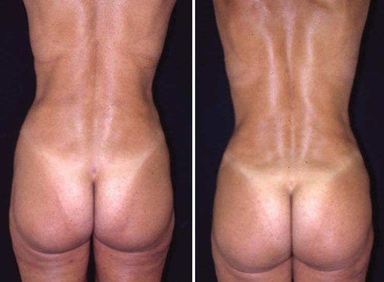 Cosmetic Surgery in Egypt Fat Liposuction Buttock lift implant  cairo tuck 