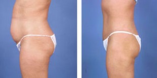 Laser Liposuction,Smart liposuction,Abdominal Liposuction,Egypt,Plastic Surgery