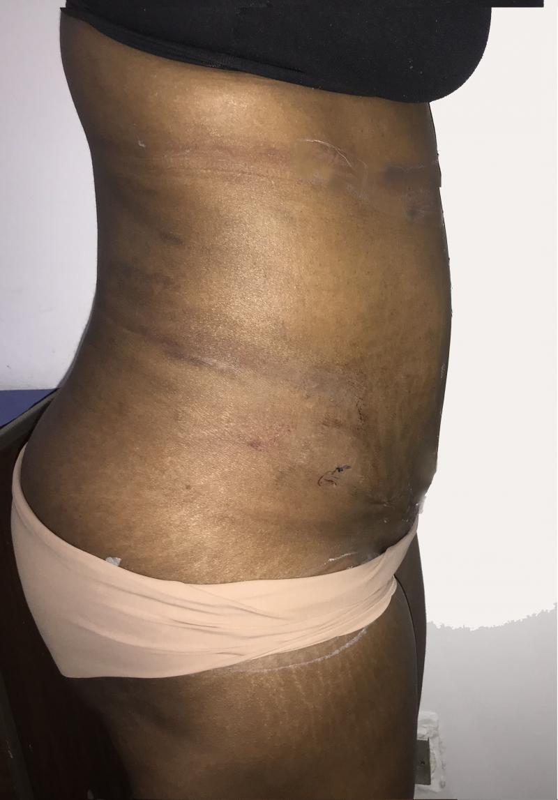 $D High Definition Vaser Liposuction of Tummy and Flanks at Best Plastic Surgery