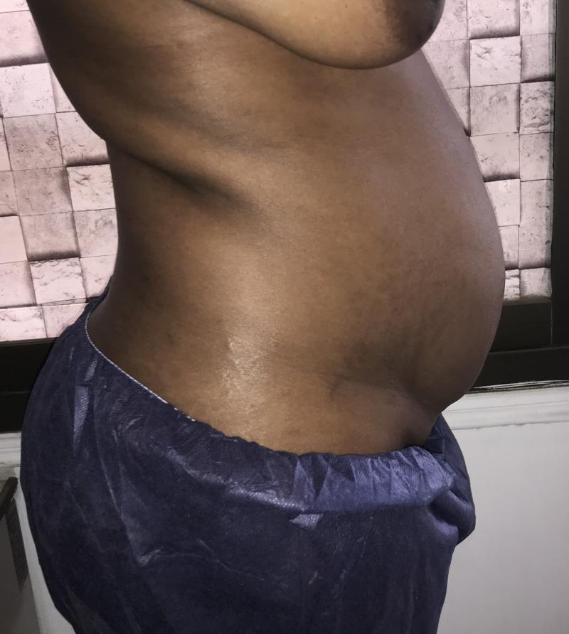 4D High Definition Vaser Liposuction of Tummy and Flanks at Best Plastic Surgery