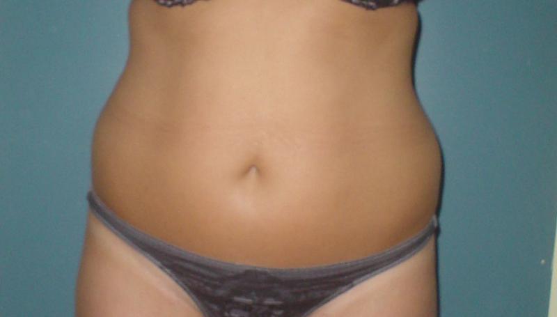Laser Liposuction Abdomen, Vaser Liposuction Abdomen, Liposculpture Abdomen