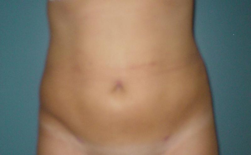 Best Cosmetic Surgery Egypt, Vaser Liposuction Abdomen, Liposculpture Abdomen