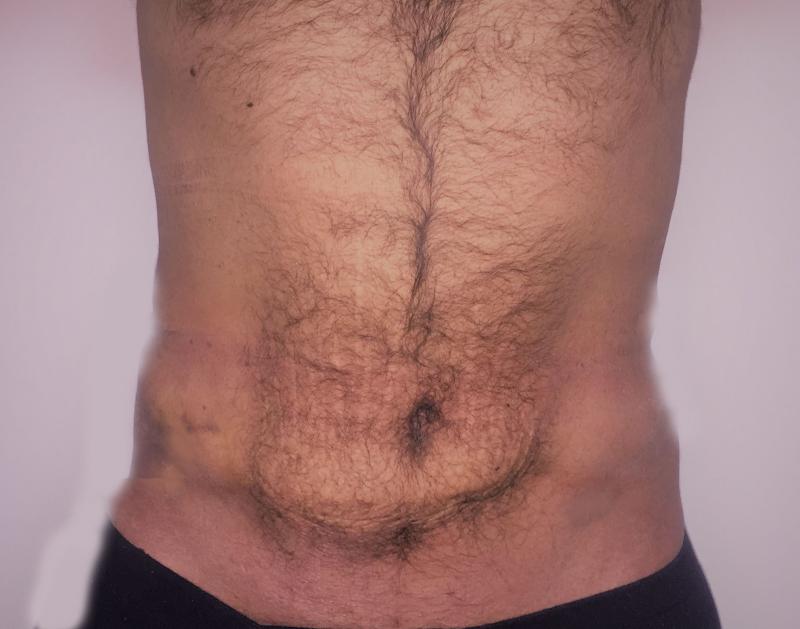 شفط الدهون بالليزر شفط الدهون بالارداف تنسيق القوام جراحة التجميل مصر smart lipo