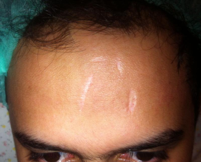 Cosmetic Surgery Egypt, Aesthetic Surgery, Stem Cells, Scar, Facial scar