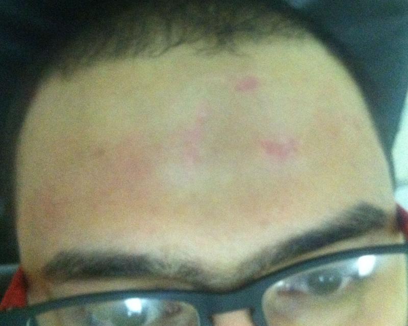 Plastic Surgery Egypt, Aesthetic Surgery, Stem Cells, Scar, Facial scar