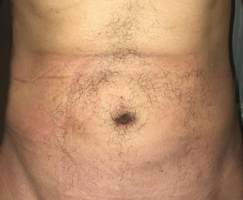 Best Plastic Surgery, 4D Lipocontouring, Laser Liposuction, Tummy Liposuction