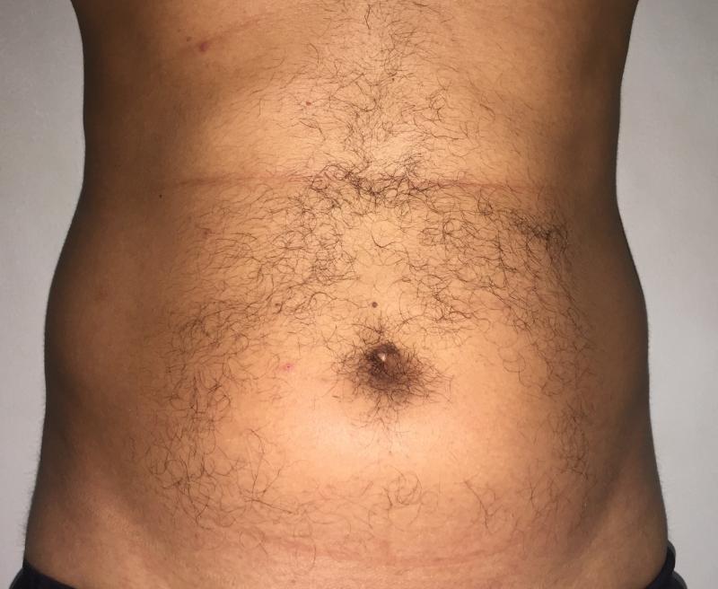 Best Cosmetic Surgery, 4D Lipocontouring, Laser Liposuction, Tummy Liposuction
