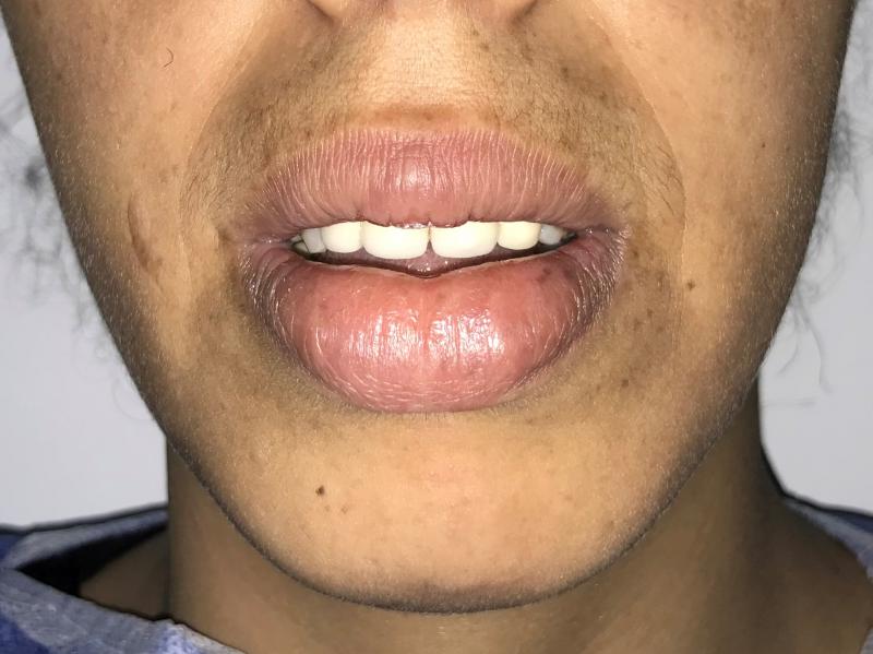 Big lips, Lip reduction, Cosmetic Lip surgery, Best Plastic Surgery, Face lift