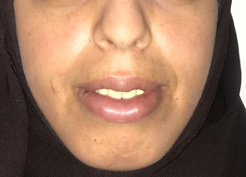 Lip surgery, Lip reduction Surgery, Best Cosmetic Surgery, Face Cosmetic