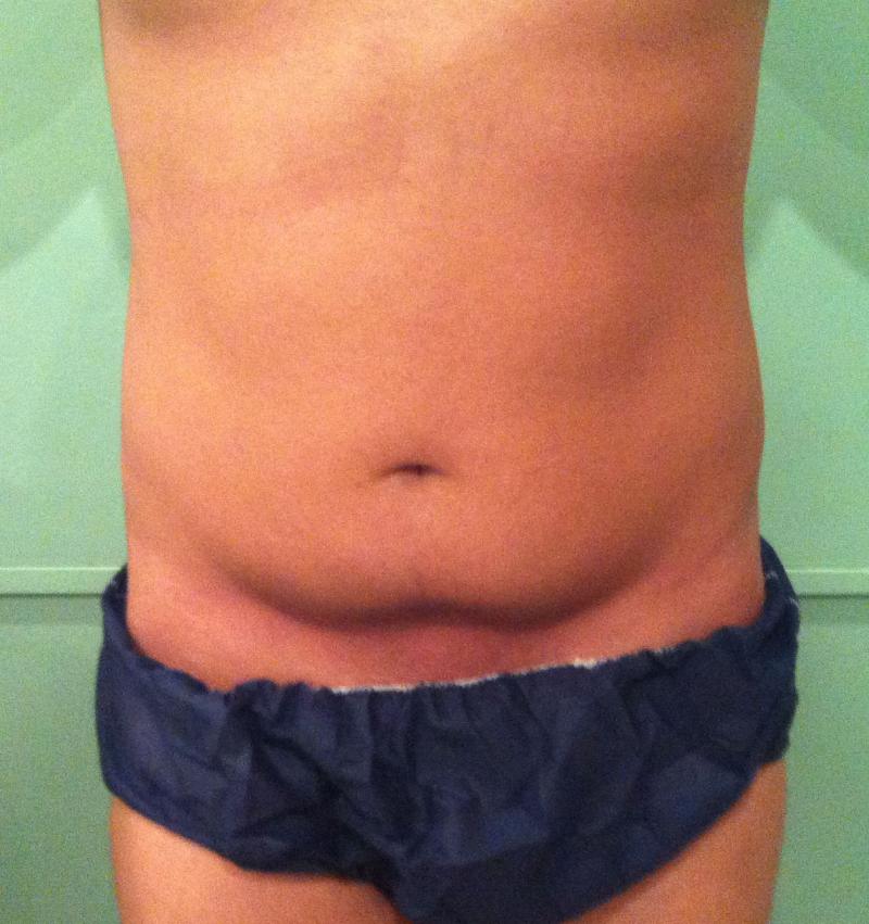Cosmetic Surgery in Egypt,Laser Liposuction,Abdomen,Fat,Obesity,Abdominoplasty