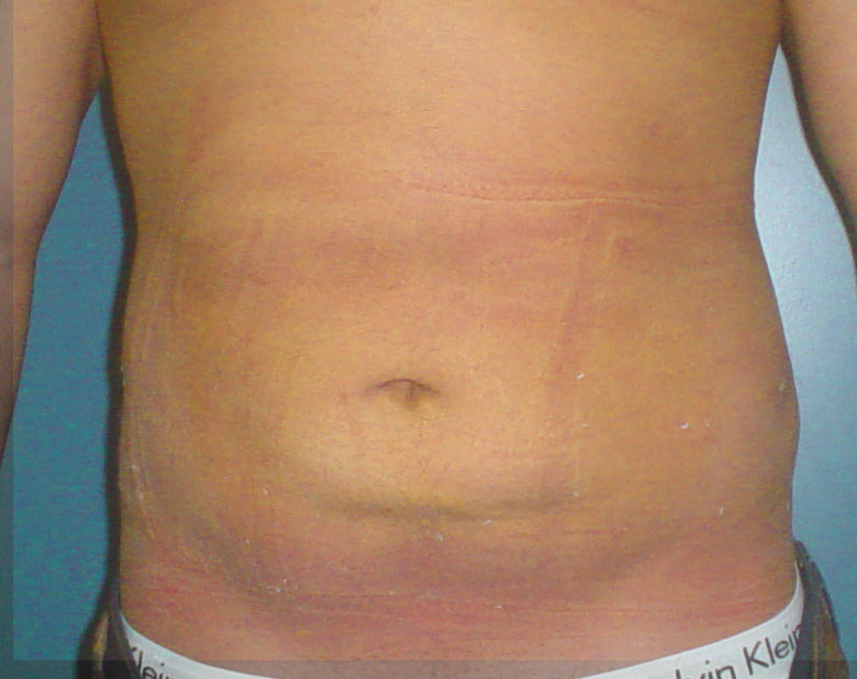 Plastic Surgery in Egypt,Abdominal Liposuction,Laser Liposuction,Fat,Obesity