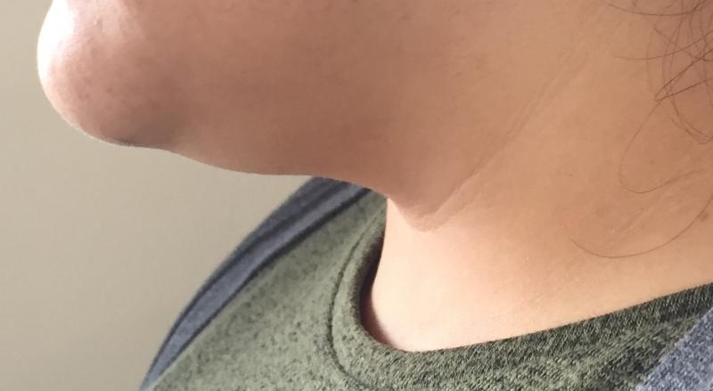 Neck Lift, Neck liposuction, double chin, Laser Liposuction, Best Cosmetic Surge