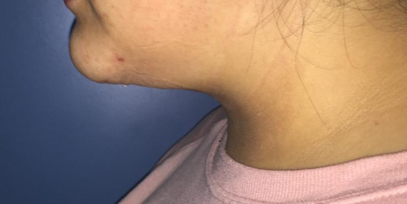 Neck Lift, Neck liposuction, double chin, Vaser Liposuction, Best Cosmetic Surge