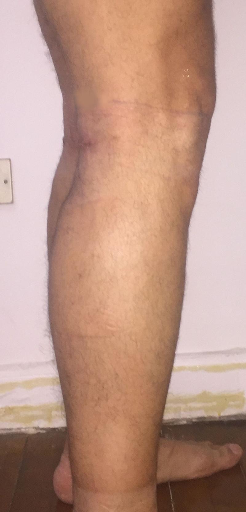 CalfImplants, Calf Enhancement, Leg enlargement, Fat graft, Best Plastic Surgery