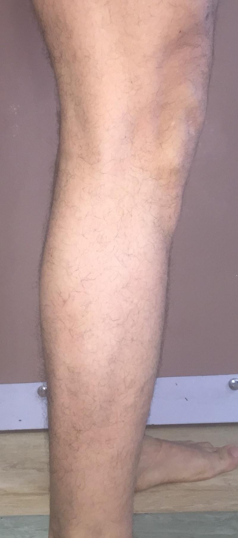 CalfImplants, Calf Enhanement, Leg enlargement, Fat graft, Best Cosmetic Sureger
