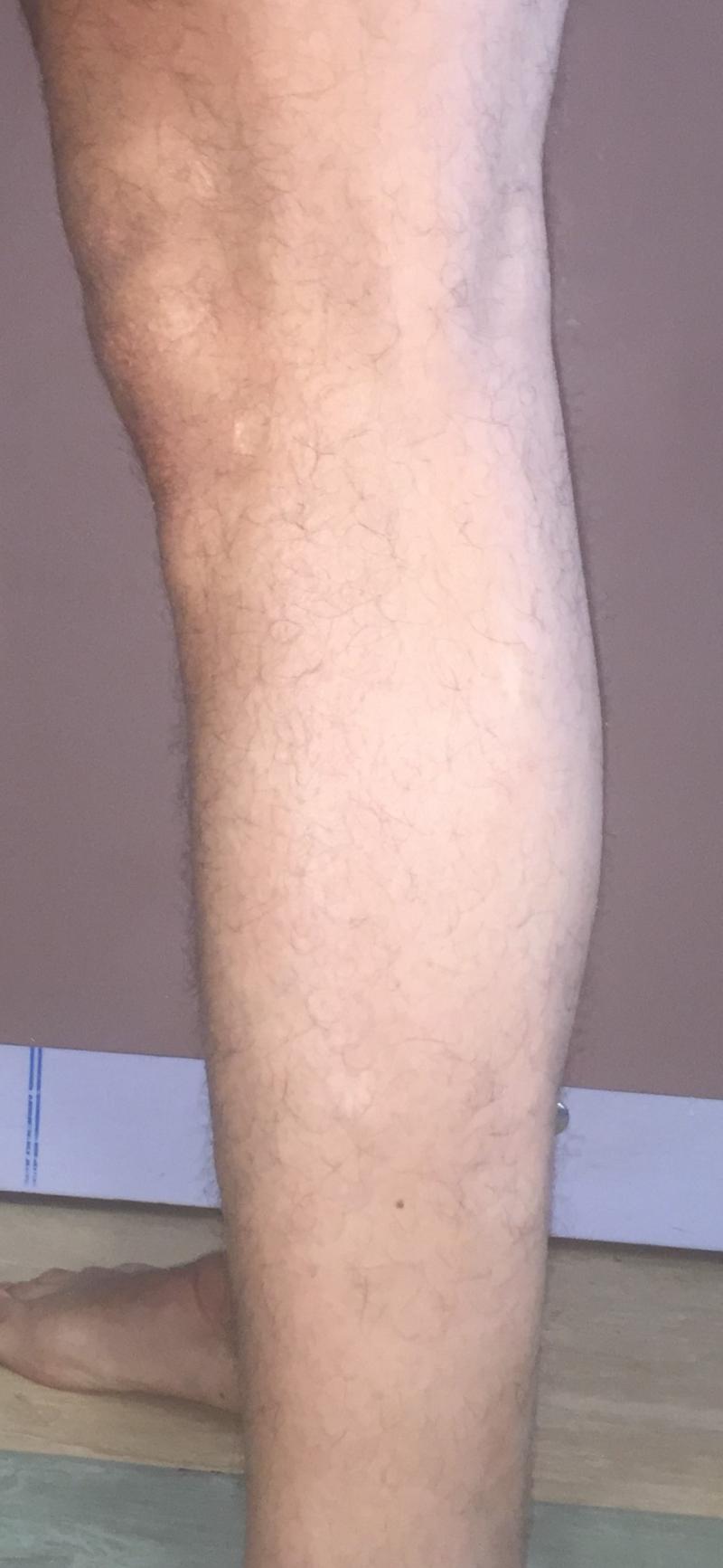 CalfImplants, Calf Enhancement, Leg enlargement, Fat graft, Best Aesthetic Surge