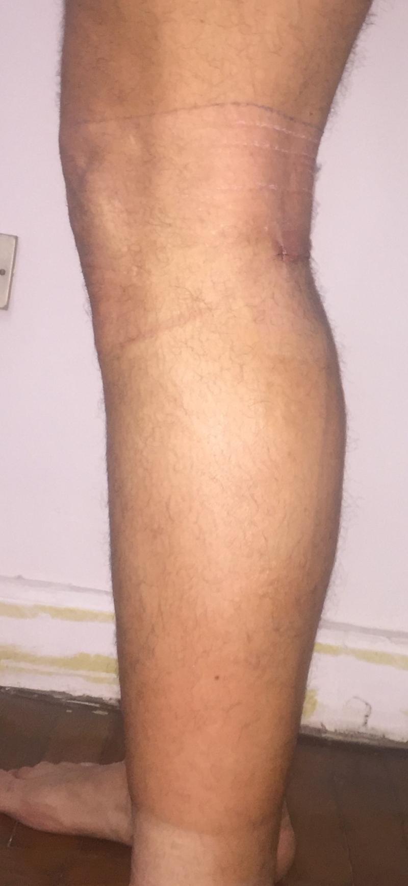 Leg Enlargement, Calf Enhancement, Calf Implants, Leg Fat Grafting, Muscular leg