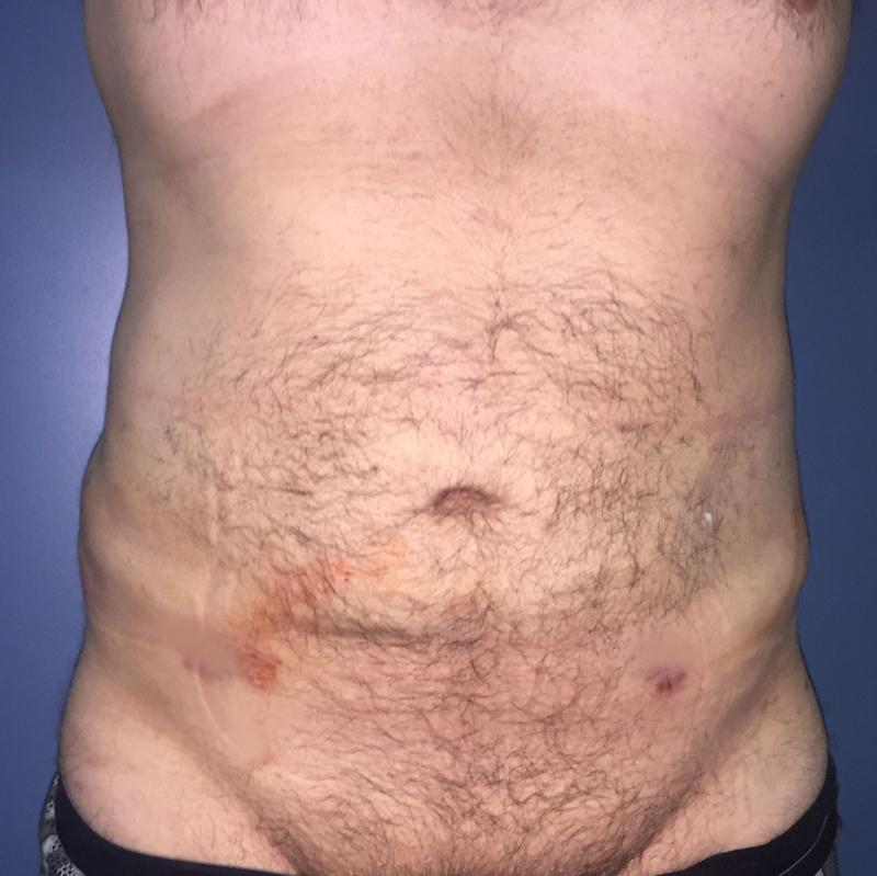 Smart Liposuction, Liposculpture, 4-D Liposuction, Laser Liposuction, Cosmetic S