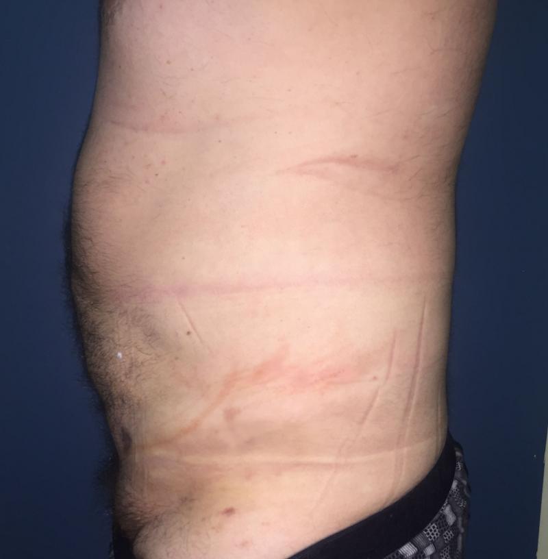 Smart Liposuction, Liposculpture, 4-D Liposuction, Vaser Liposuction, Cosmetic S