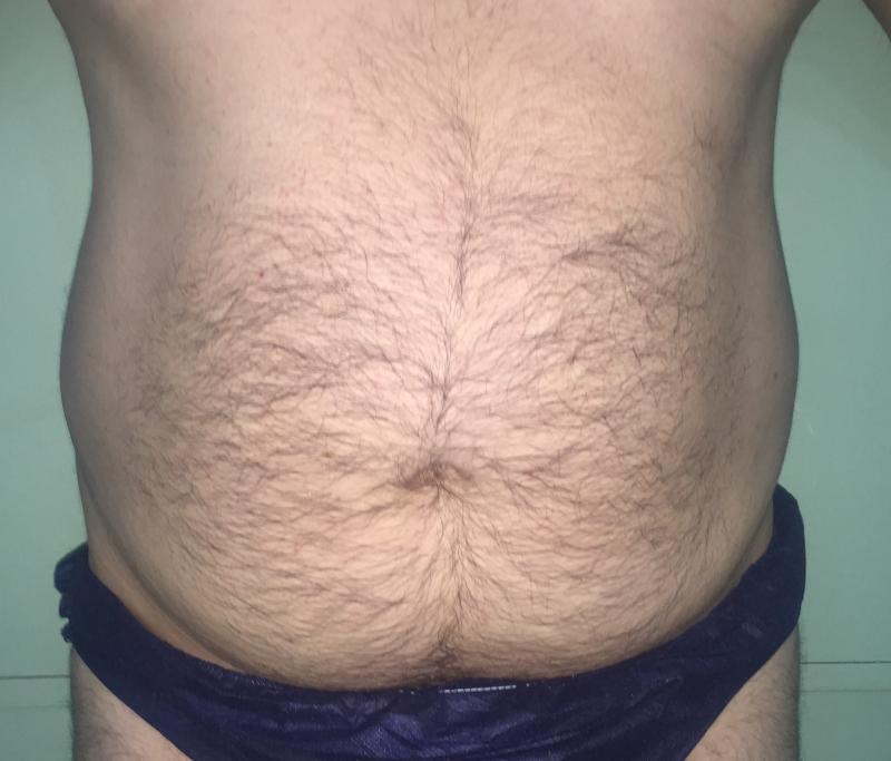 Smart Liposuction, Liposculpture, 4-D Liposuction, Laser Liposuction, Plastic Su