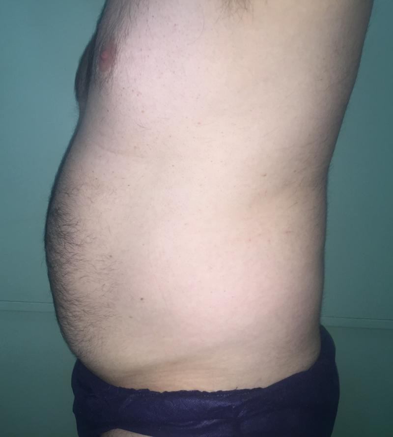 Smart Liposuction, Liposculpture, 4-D Liposuction, Vaser Liposuction, Plastic Su