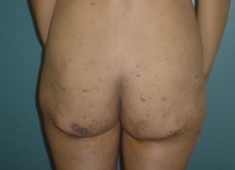 Cosmetic Surgery in Egypt,Buttock lift,Plastic surgery in egypt, Laser Liposucti