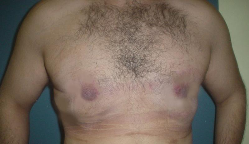 Male Breast Reduction Egypt, Gynecomastia  Vaser Liposuction, Best Cosmetic Surg