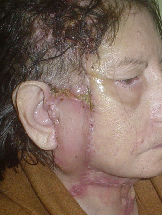 Face Lift, Neck Lift, Eyelid Surgery, Best Plastic Surgeon Egypt, Neck Liposucti
