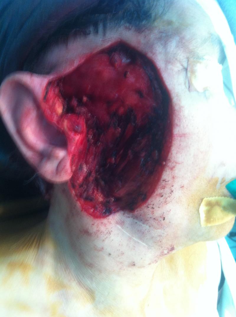 Cosmetic Surgery Egypt, Face Lift, Face surgery, Eyelid surgery, Face Tumour