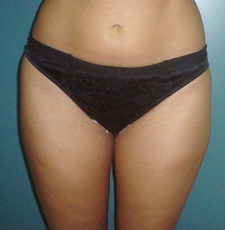 Egypt Cosmetic Surgery,Thigh Liposuction,Laser Liposuction,Smart Liposuction