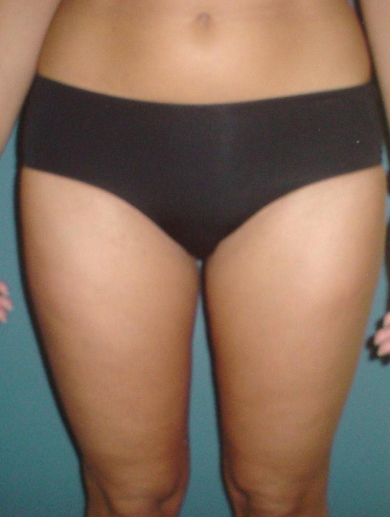 Plastic Surgery Egypt,Liposuction,Thigh Laser Liposuction,Smart Liposuction